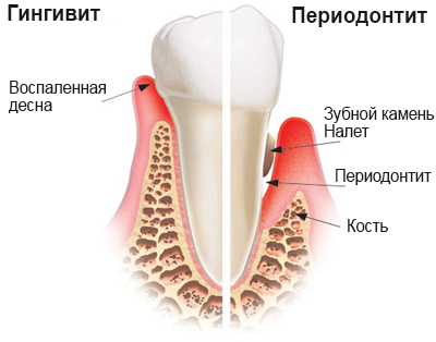 periodontit.png