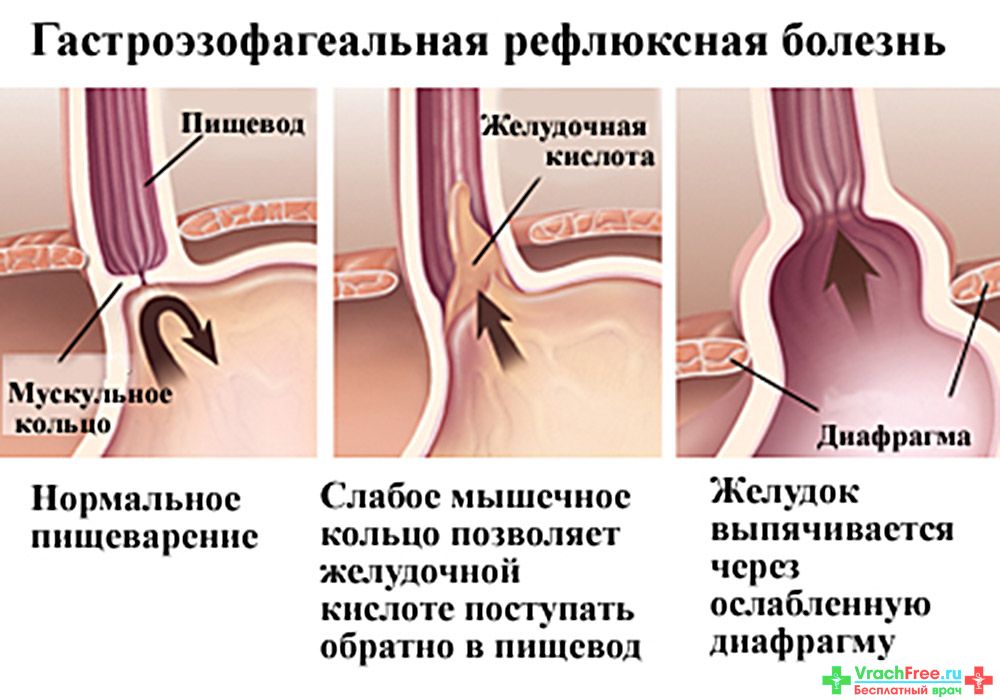Гастроэзофагеальной рефлюксной болезни как лечить Гастроэзофагеальной рефлюксной болезни как лечить