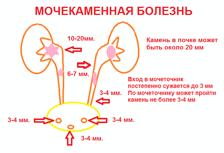 Как лечить мочекаменную болезнь народная медицина Как лечить мочекаменную болезнь народная медицина