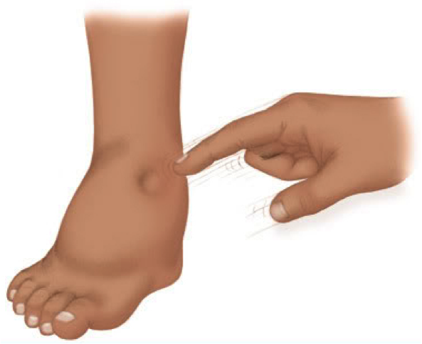 swollen.png