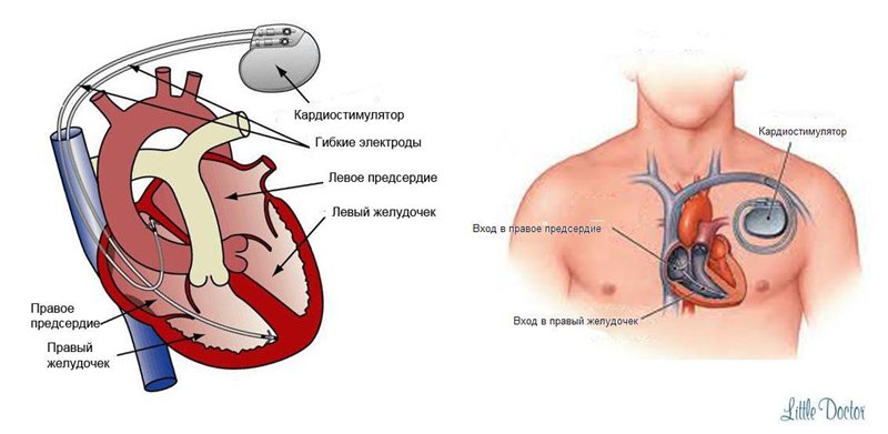 Сколько живут с кардиостимулятором. Кардиостимулятор двухкамерный показания. Схема установки кардиостимулятора. Операция кардиостимулятор сердца. Имплантация электрокардиостимулятора (экс).