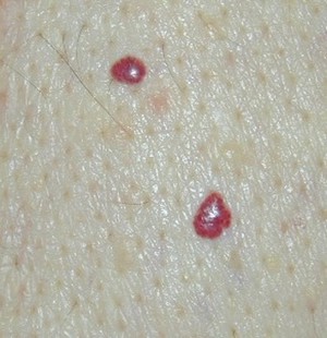simptomy-gemangiomy.jpg