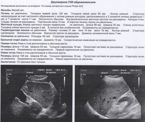 Размер печени у взрослого мужчины по узи. Добавочная долька селезенки на УЗИ. Доли печени по УЗИ. УЗИ печени норма.