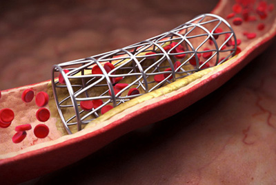 Stent-v-sosude.jpg