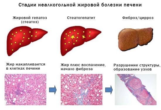  жировая болезнь печени