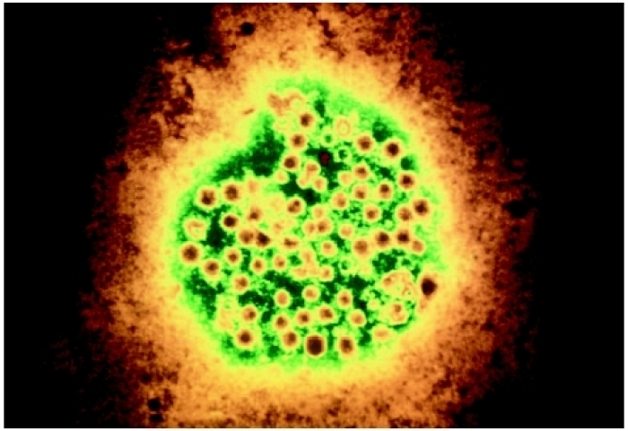Вирусные гепатиты классификация по активности thumbnail